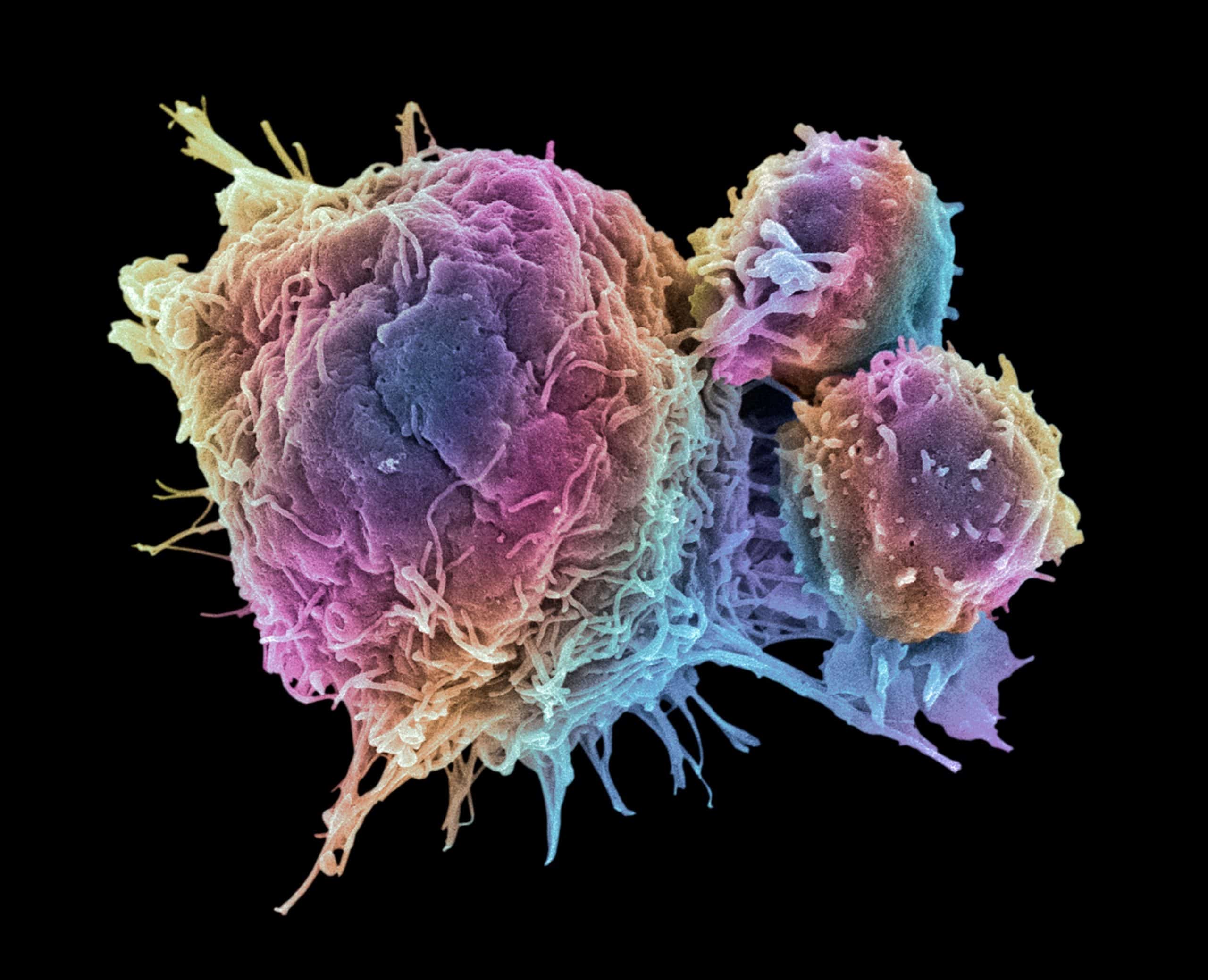 Colored scan of T lymphocytes and a cancer cell