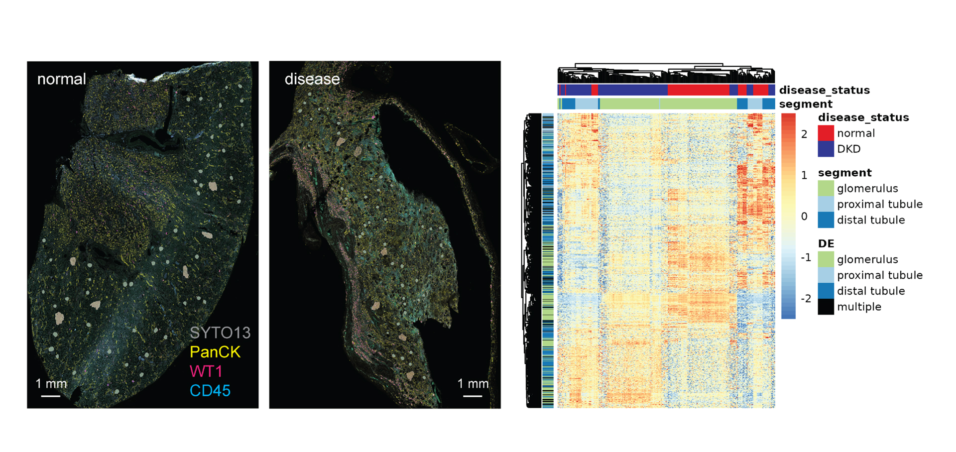 Identifying spatial signatures of diabetic kidney disease